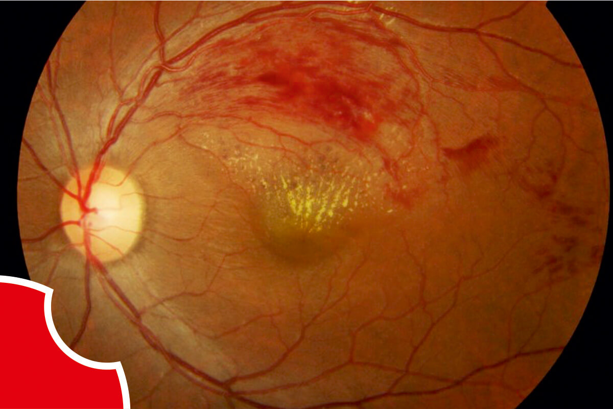 Medical retina treatment