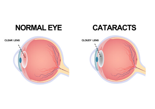 Cataract surgery