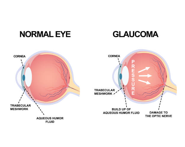 What is Glaucoma?